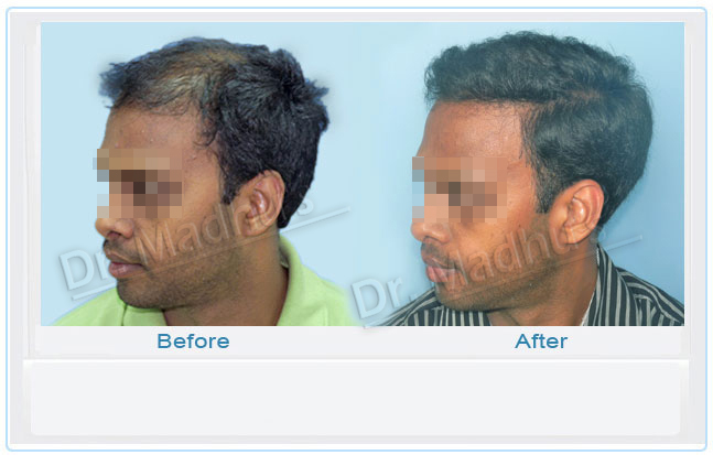 images-hair-transplant