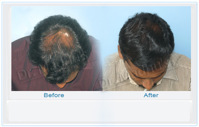 images-hair-transplant