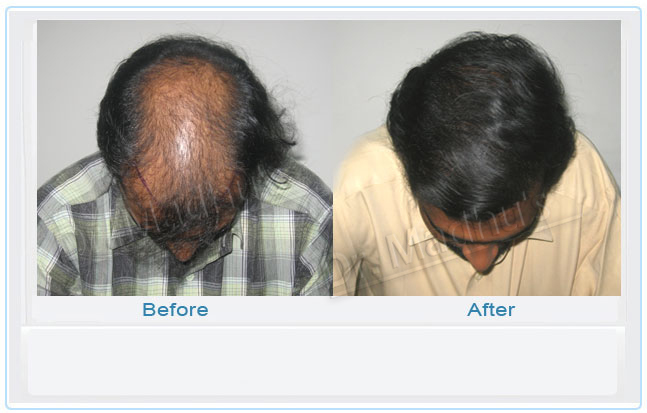 images-hair-transplant