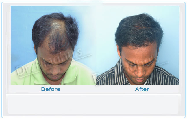 images-hair-transplant