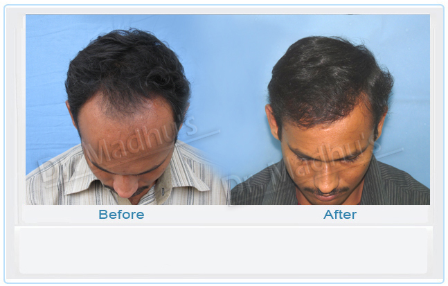 images-hair-transplant