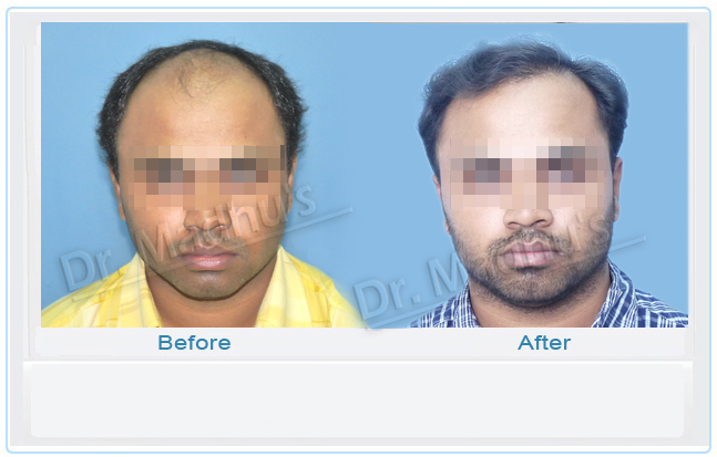 images-hair-transplant