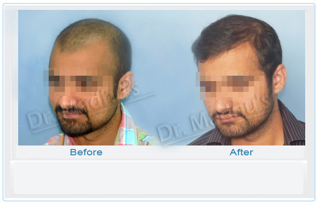 images-hair-transplant