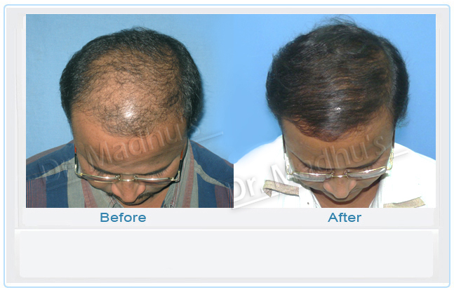 images-hair-transplant