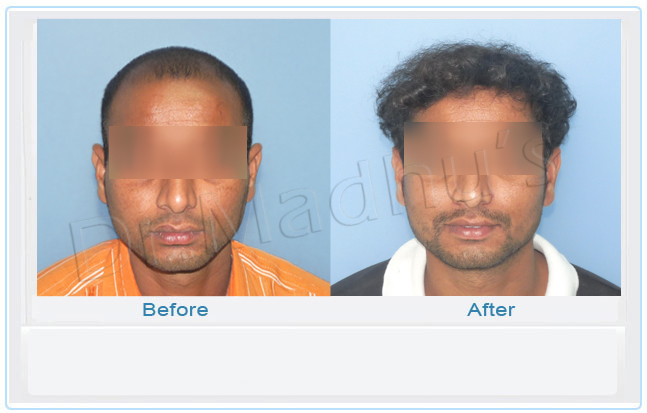 images-hair-transplant