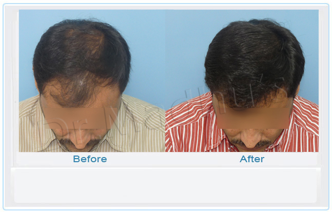 images-hair-transplant