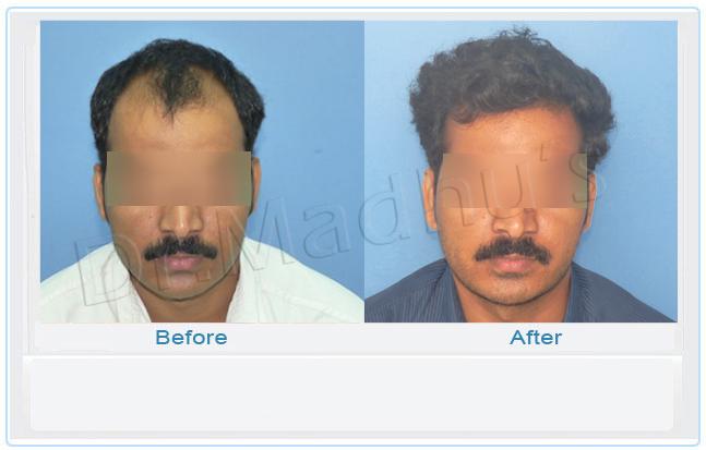 images-hair-transplant