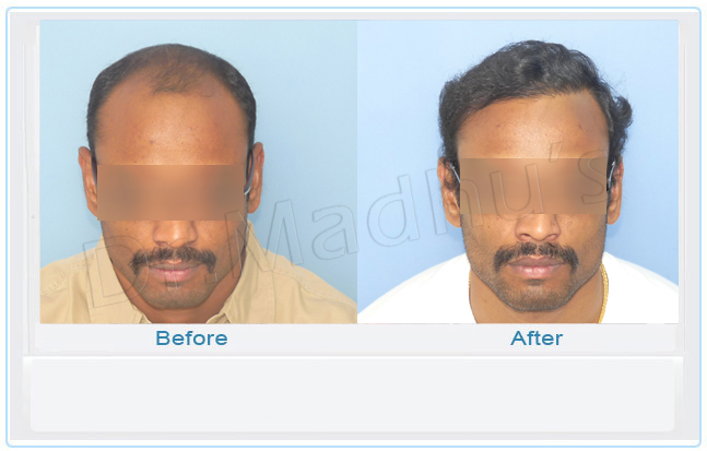 images-hair-transplant