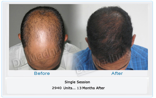 images-hair-transplant-ahmedaded