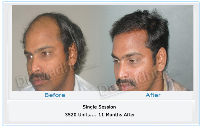 images-cosmetic-surgery-hair-transplant-india