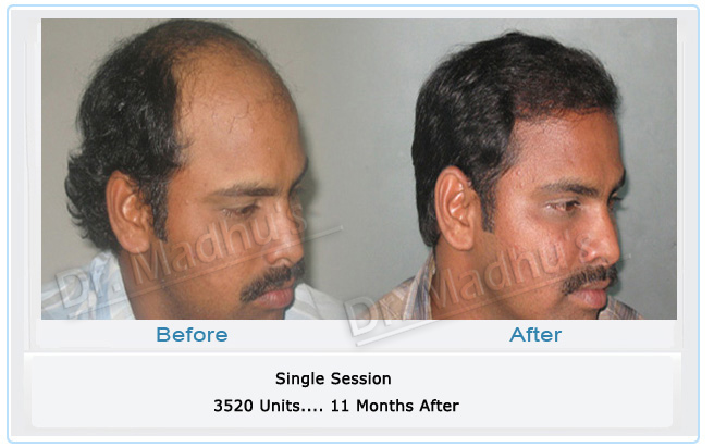 images-hair-transplant-treament-india