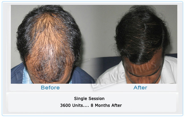 images-hair-transplant-delhi