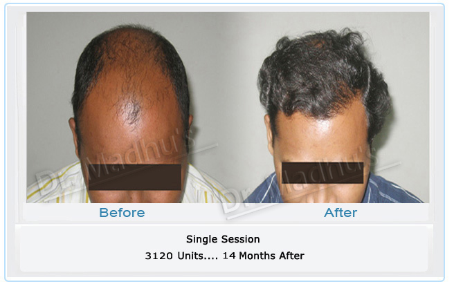 images-hair-transplant-bangalore