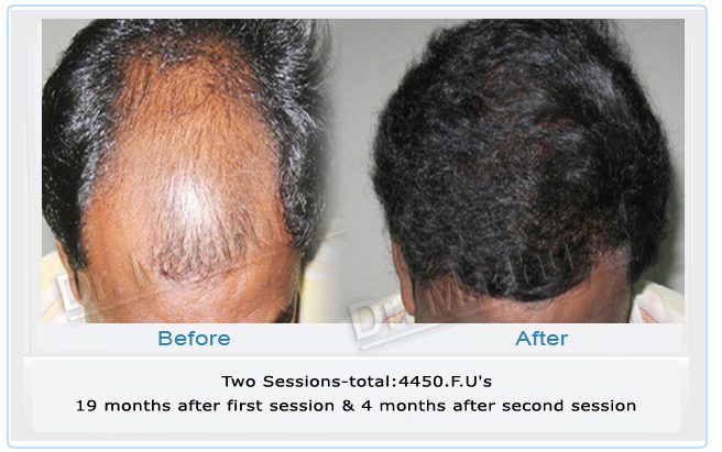 images-hair-transplant-pune