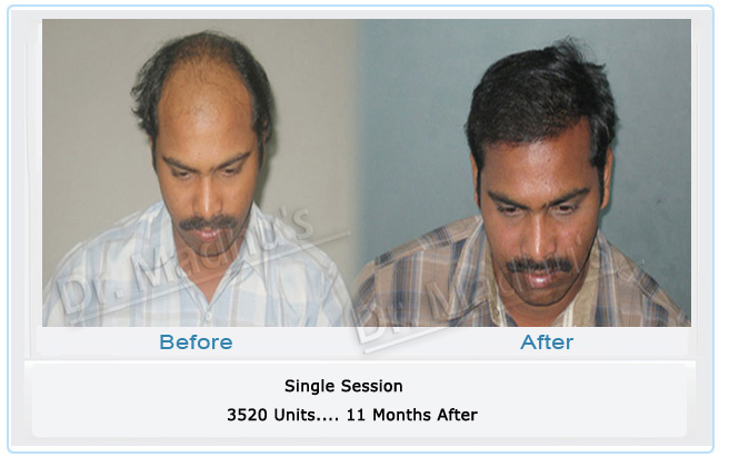 images-hair-transplant-pune