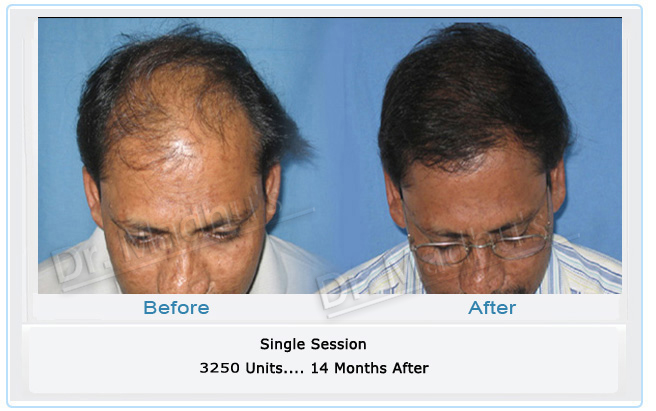 images-hair-transplant-ahmedaded